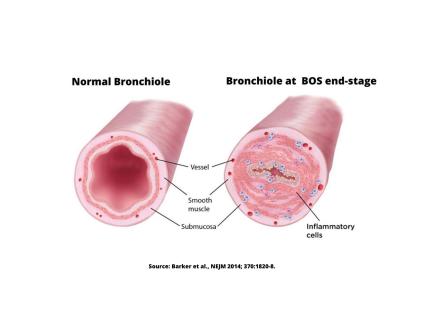 BOS Source: Barker et al., NEJM 2014; 370:1820-8.